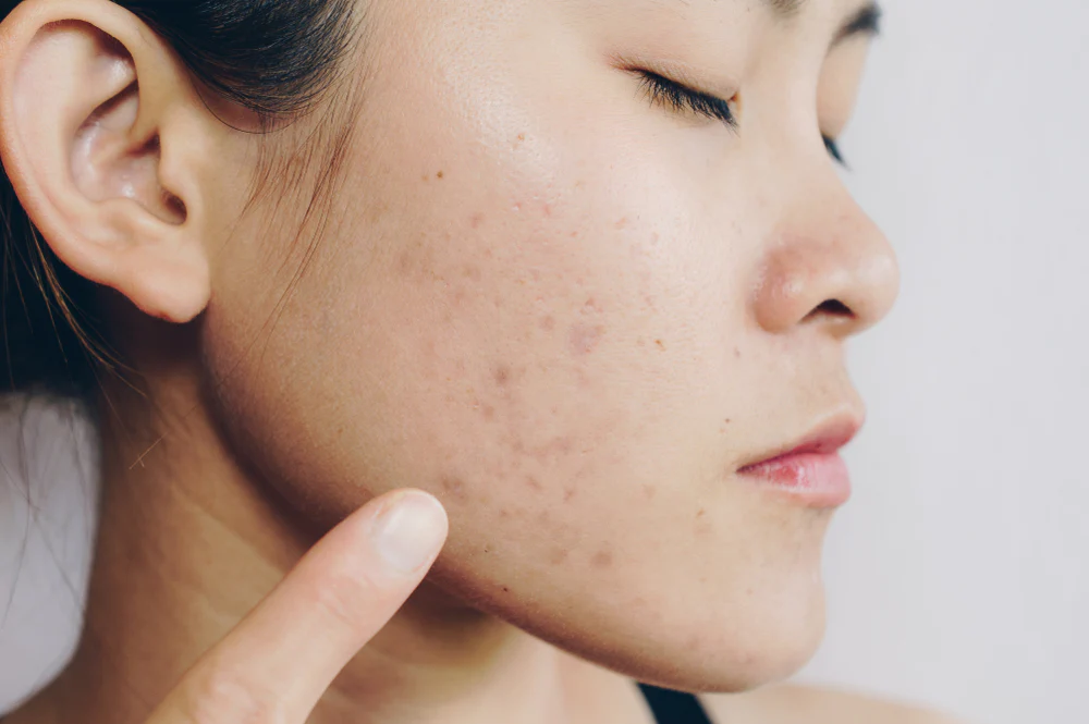 Acne Scar Treatment Norwich | The Doctors Laser Clinic